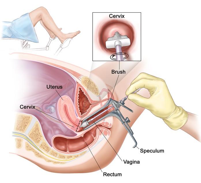 Rak maternice seks kad imate Oralni seks